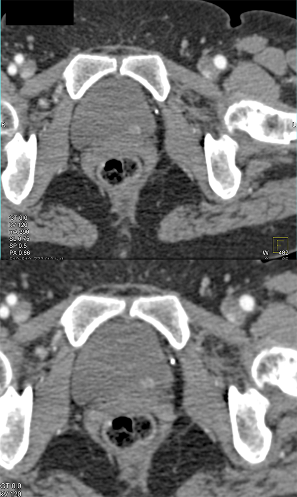 Bladder Cancer-Subtle Enhancement