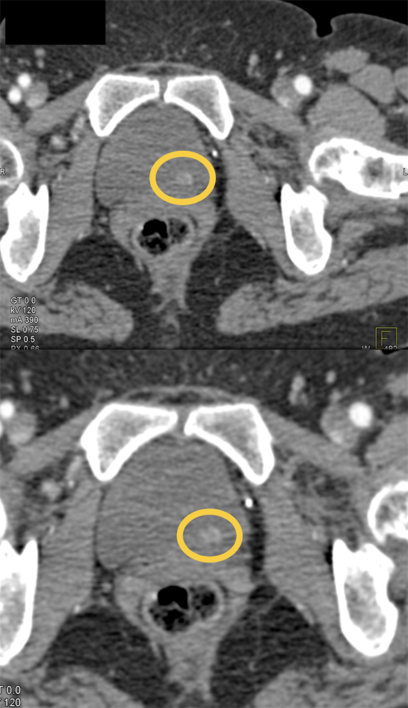 CT of Hematuria