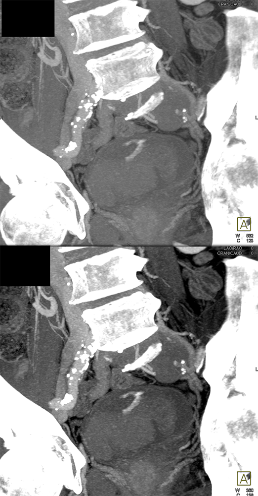 CT of Hematuria