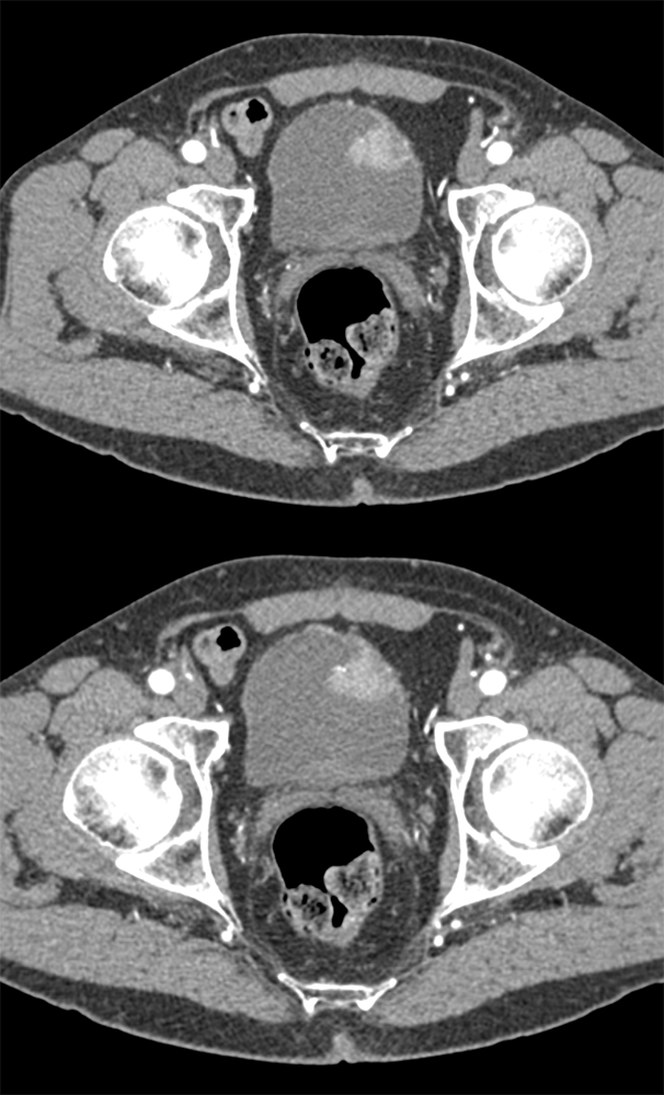 Bladder Cancer in Patient with hematuria