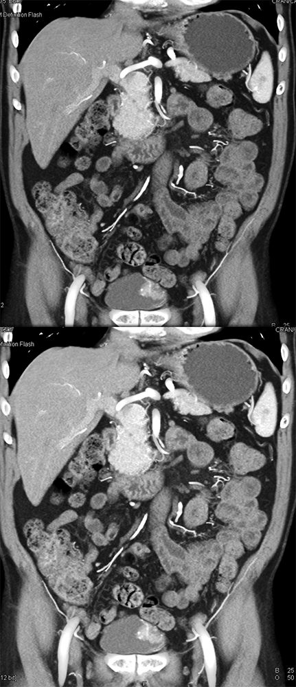 CT of Hematuria