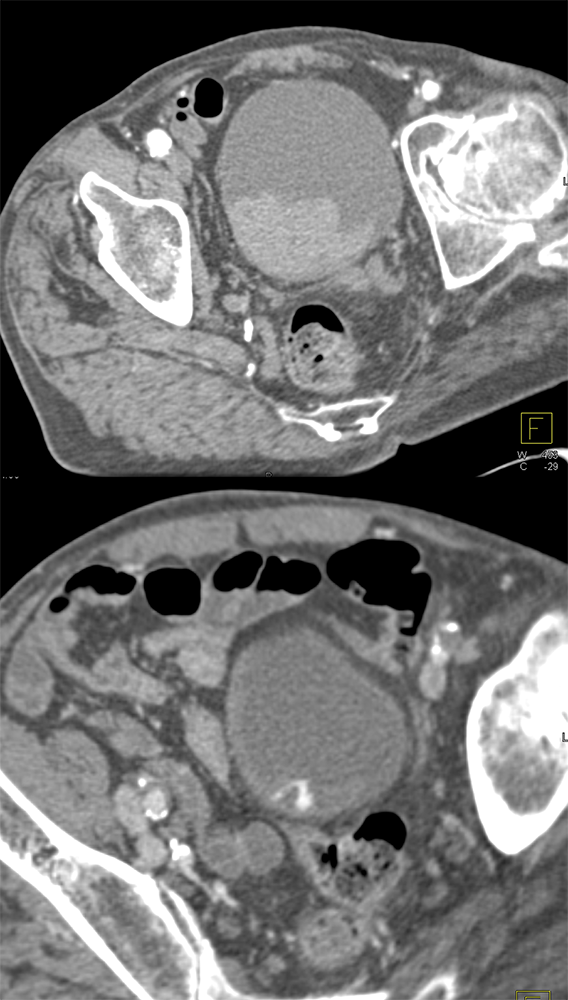 Active Bleed in Bladder: Dx