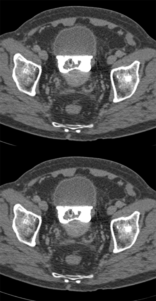 Blood Clot in Bladder