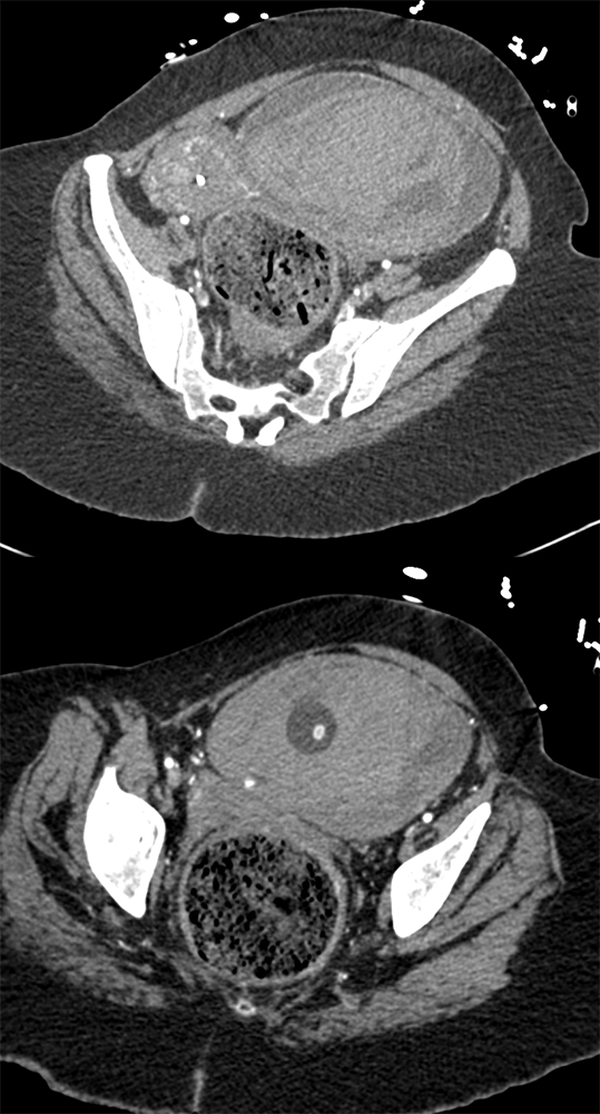 Hematuria Following Catheterization