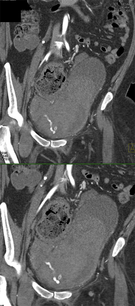 Active Bleed in Bladder Following Cath