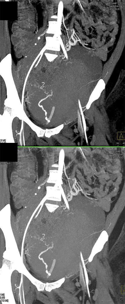 CT of Hematuria
