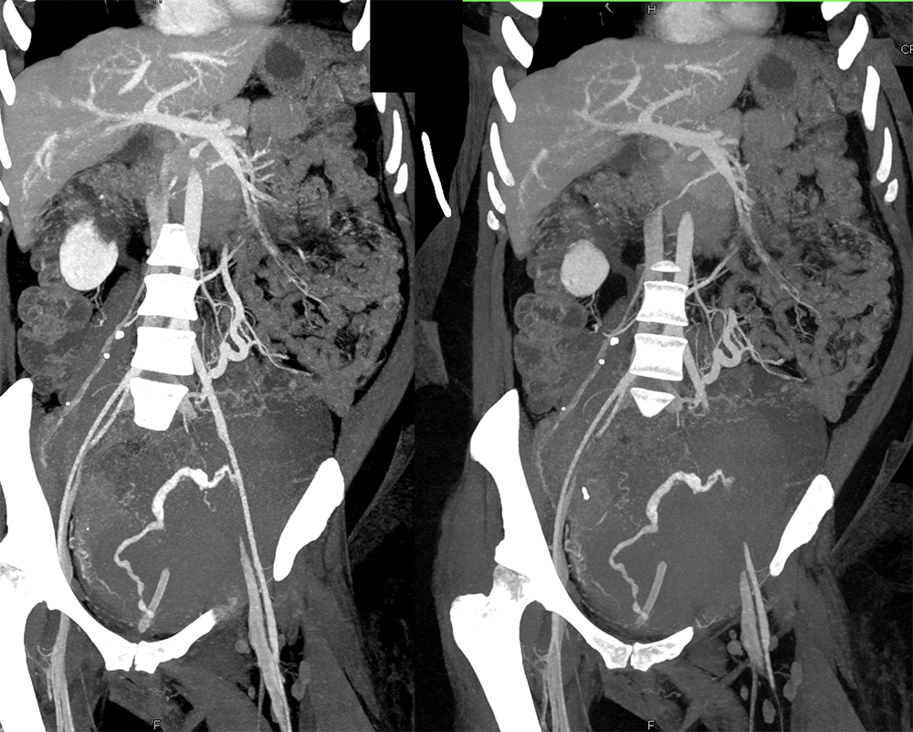 CT of Hematuria