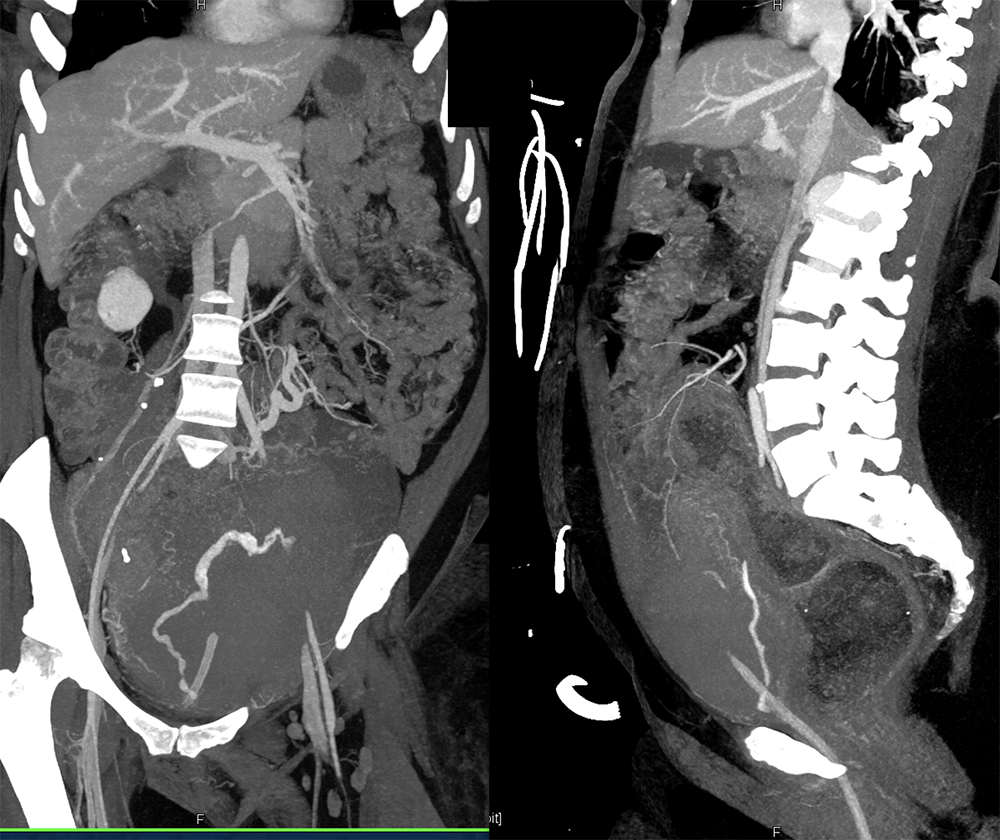 CT of Hematuria