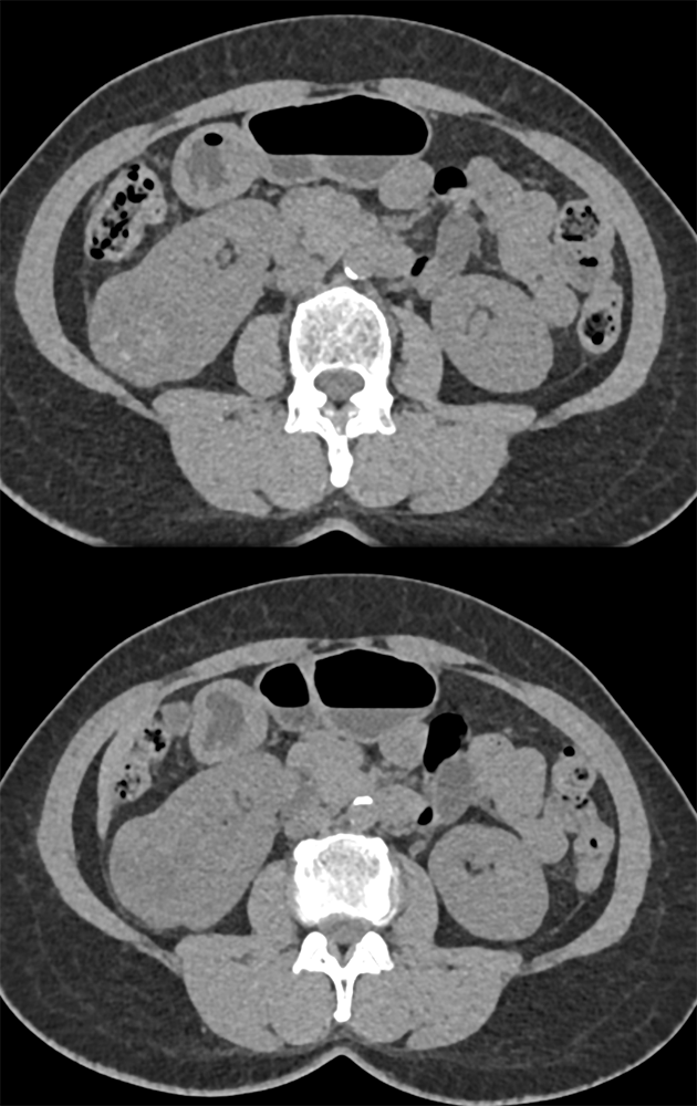 Clear Cell Renal Cell Carcinoma