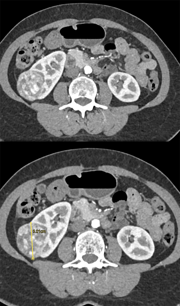 CT of Hematuria