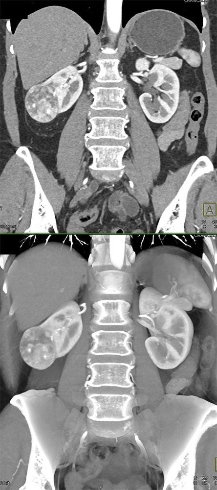 CT of Hematuria
