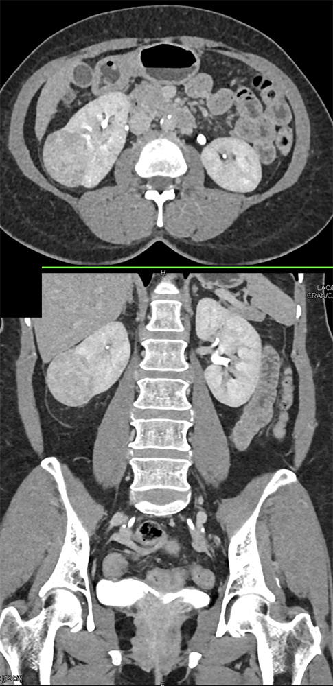 CT of Hematuria