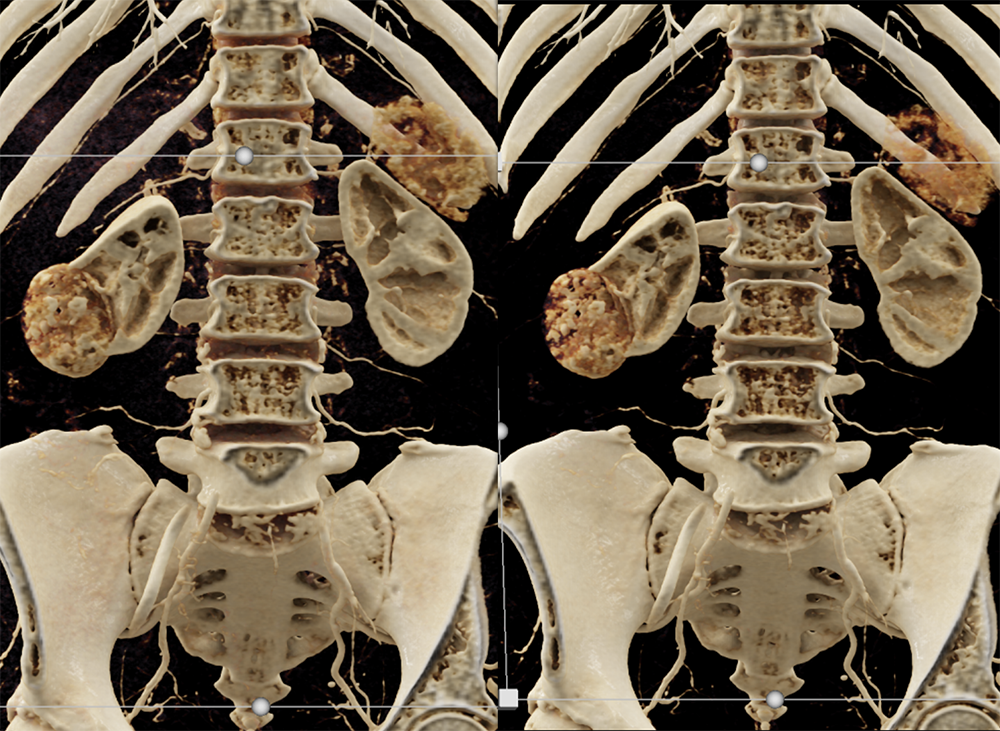 CT of Hematuria