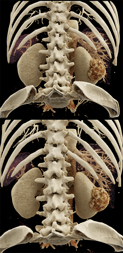 CT of Hematuria