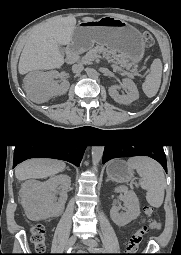 Clear Cell RCC