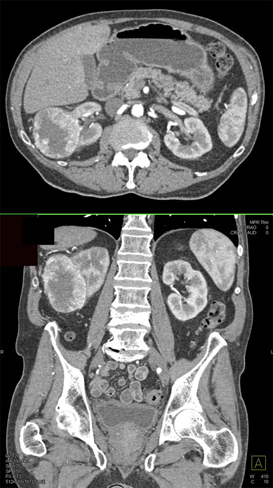 CT of Hematuria