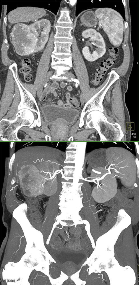 CT of Hematuria