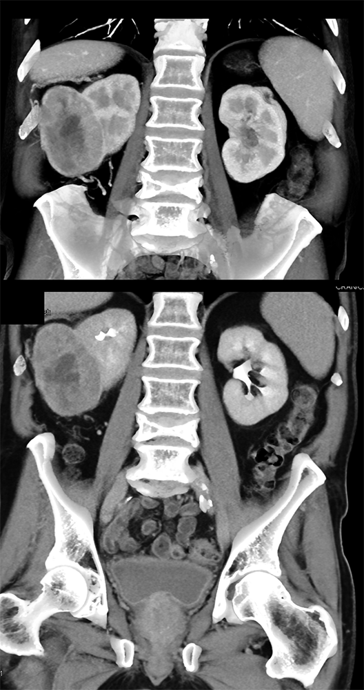 CT of Hematuria