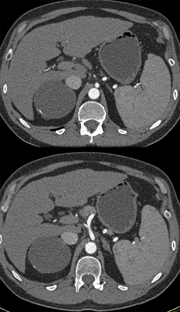 Incidental Finding-Adrenal Cyst