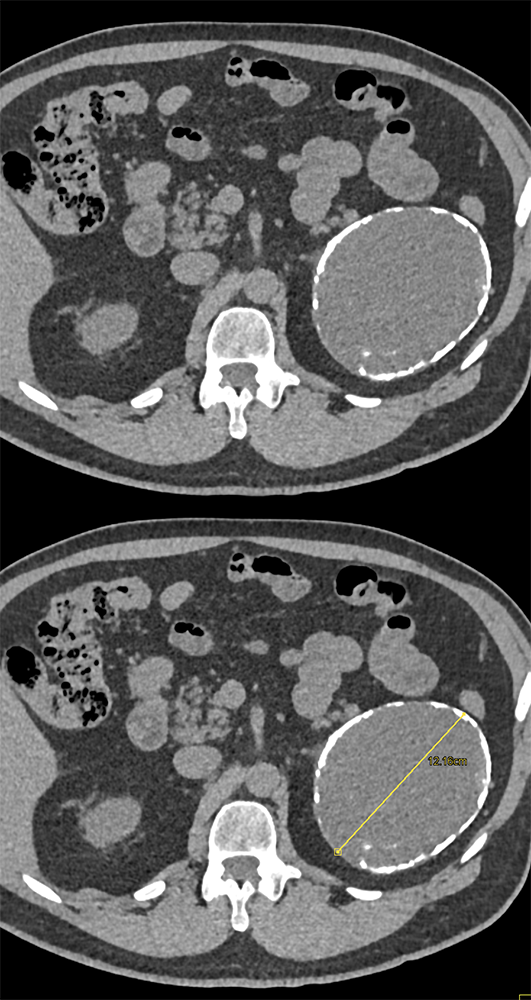 Calcified Adrenal Mass 12cm was Endothelial Cyst