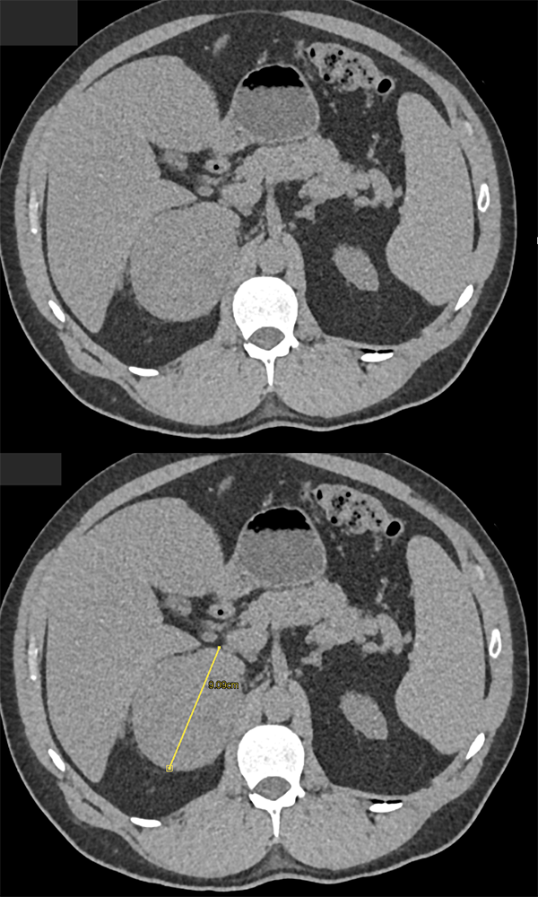 Gastrointestinal Learning Modules Ctisus Ct Scanning