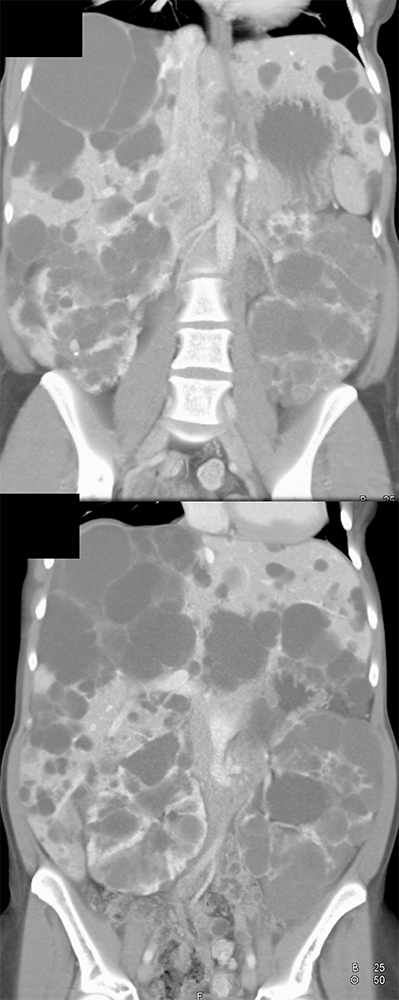 CT of Liver Masses