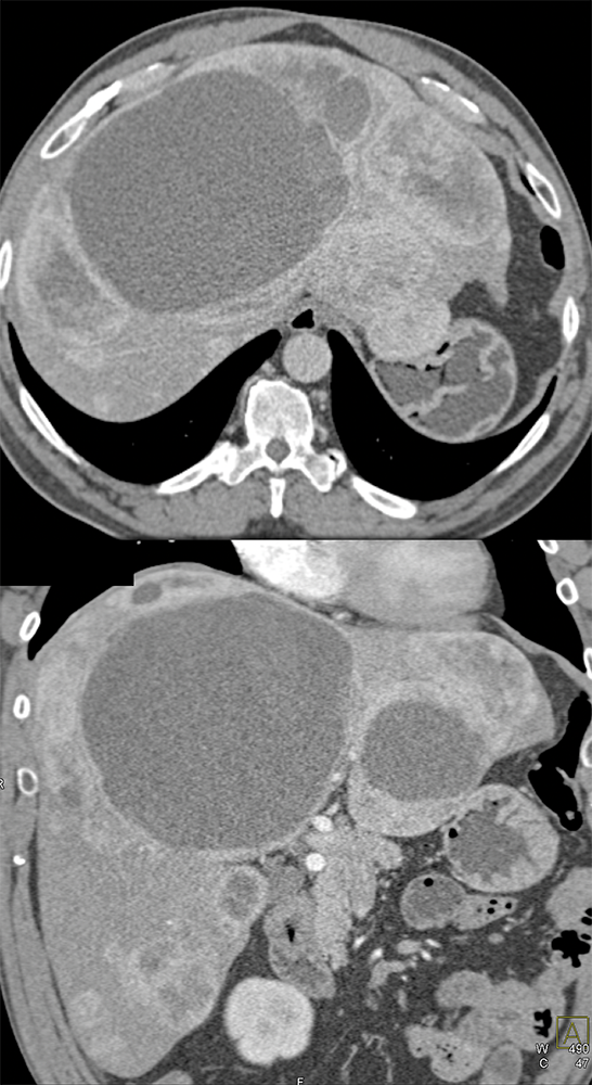 Cystic Liver Metastases from a Carcinoid Tumor