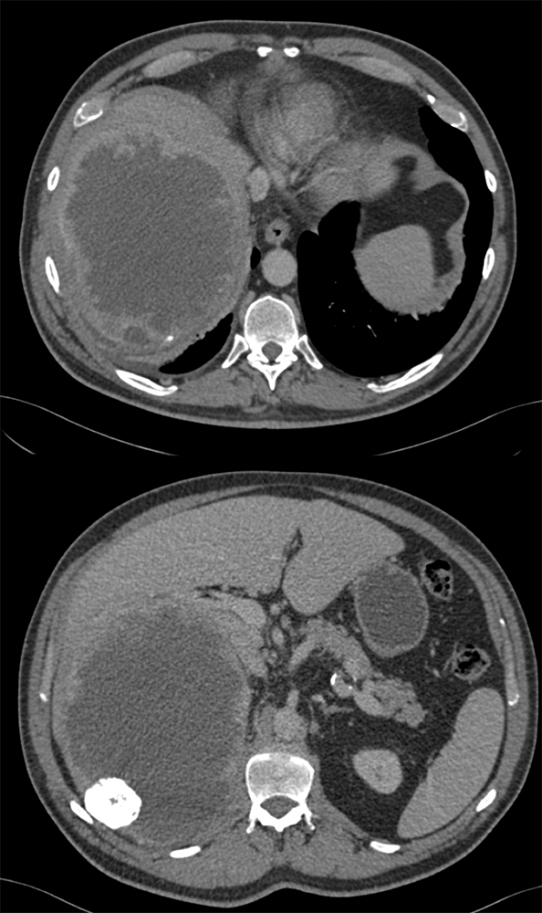 Cystic Mass Liver due Spindle Cell Sarcoma