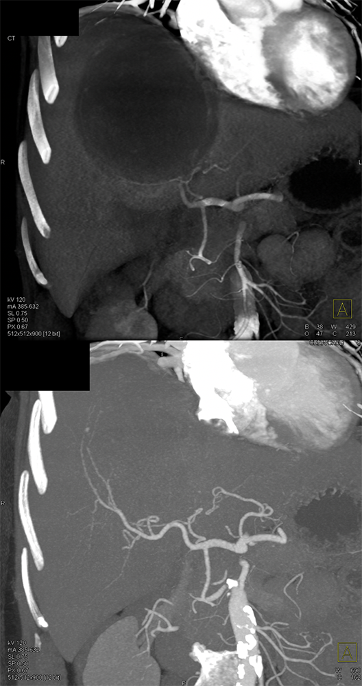 GIST Tumor Small Bowel with Cystic Liver Metastases