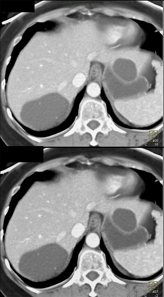 CT of Liver Masses