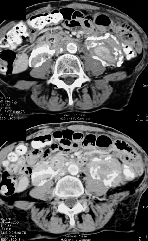 CT of the Perirenal Space