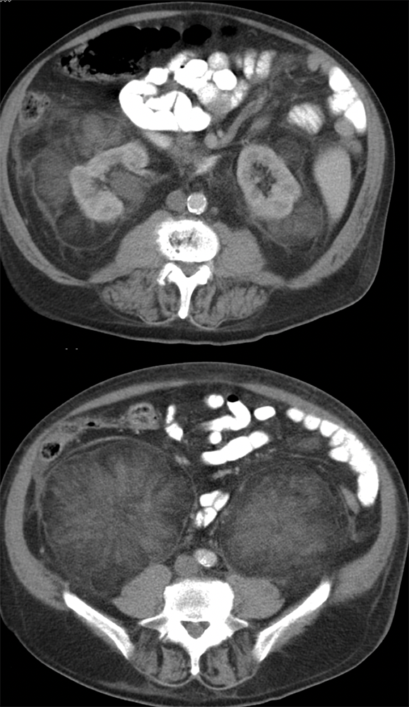 CT of the Perirenal Space
