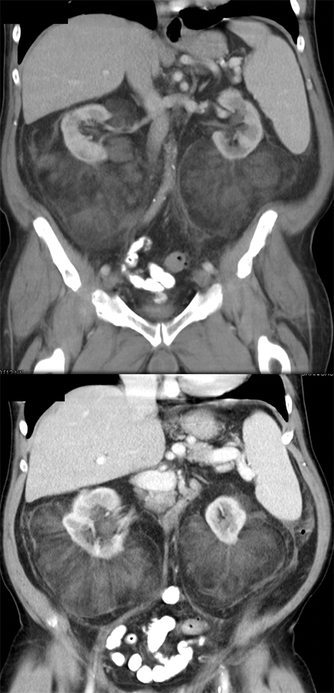 Bilateral Perirenal Fat Infiltration that was Benign Adipose Tissue