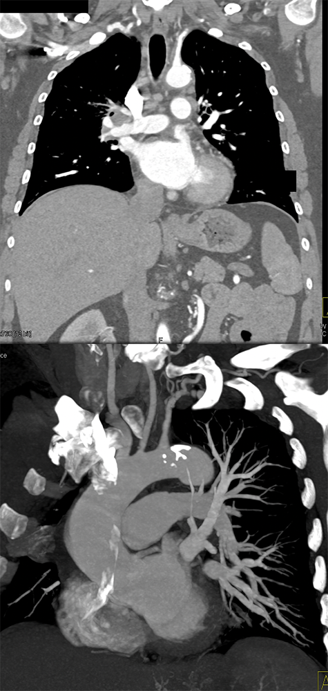Takayasu’s Aortitis and Incidental Pericardial Cyst