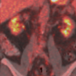 CT/PET Scanning