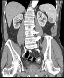 MDCT Of The Spleen CTisus CT Scanning