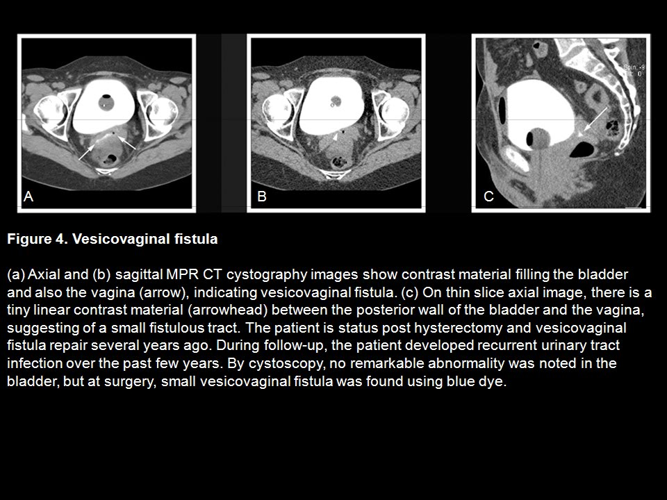 CT Cystography: The Role of 3D/MPR Imaging for Evaluation of Non-Neoplastic Disease of the Bladder