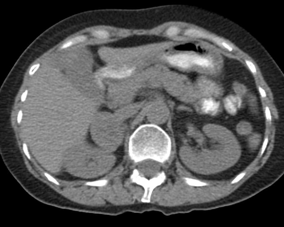 Metastases to the Left Adrenal Gland from Lung Cancer