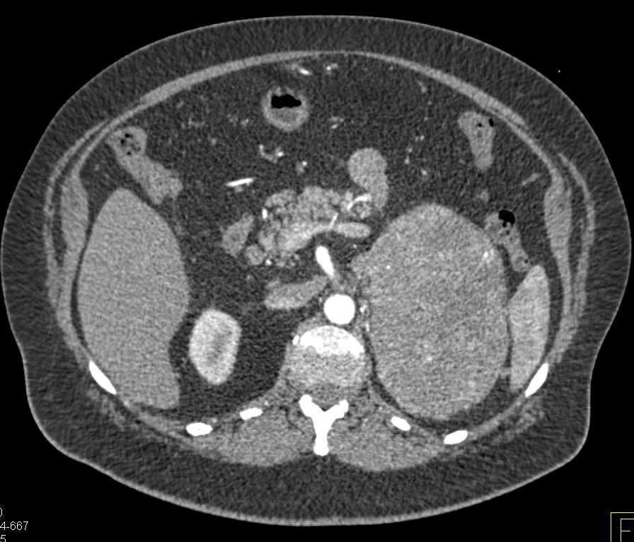 Adrenal Cortical Carcinoma - CTisus CT Scan