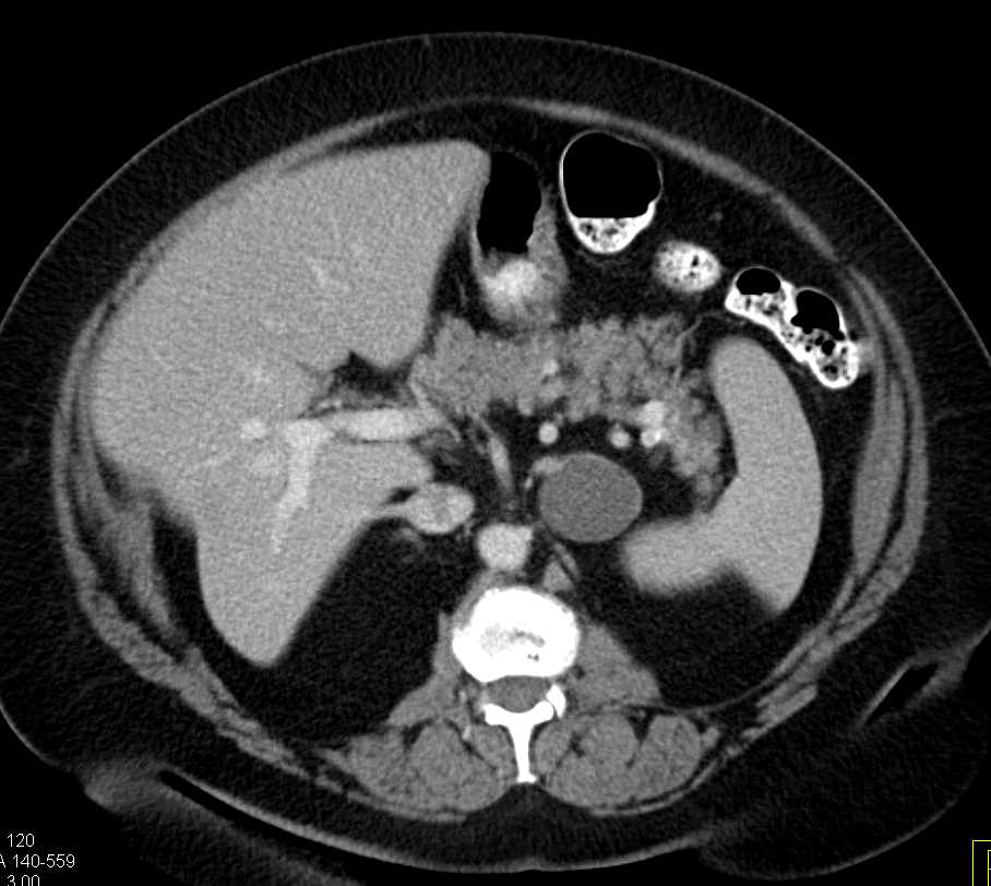 Left Adrenal Lymphangioma - CTisus CT Scan