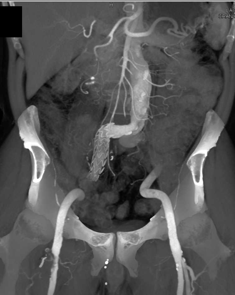 Proximal SFA Stenosis - Adrenal Case Studies - CTisus CT Scanning
