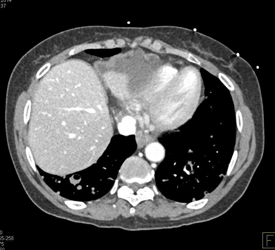 Carcinomatosis with Cavitary Lung Metastases due to