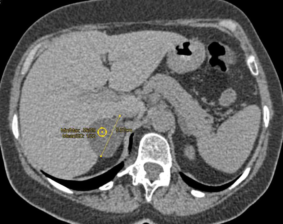 Right Adrenal Adenoma - Adrenal Case Studies - CTisus CT Scanning