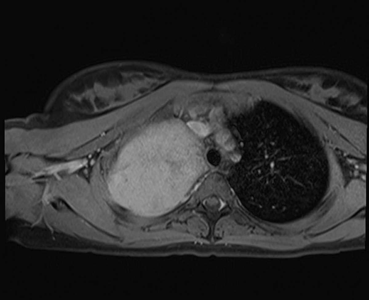 Chest Wall Desmoid Tumor Body MR Case Studies CTisus CT Scanning