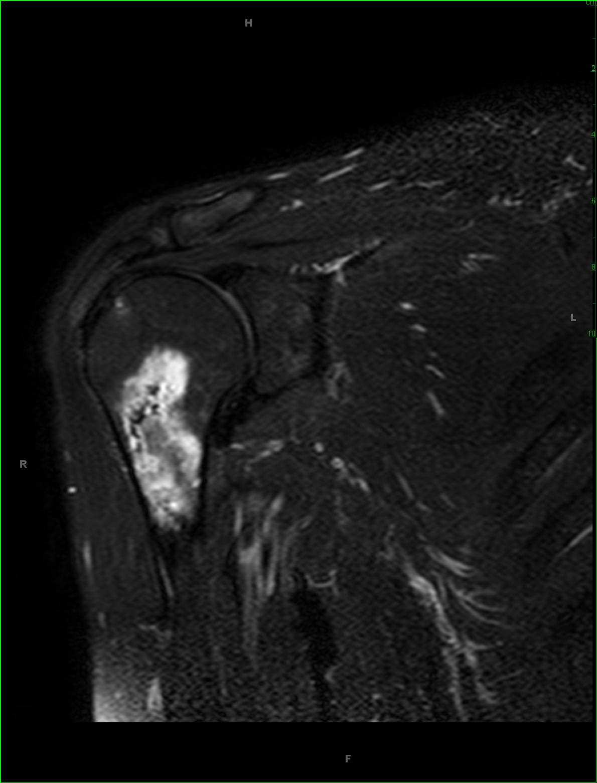 Bone Infarct, Humerus - Body MR Case Studies - CTisus CT Scanning