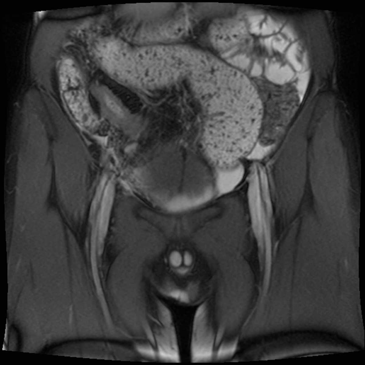 Crohn's Disease - CTisus CT Scan