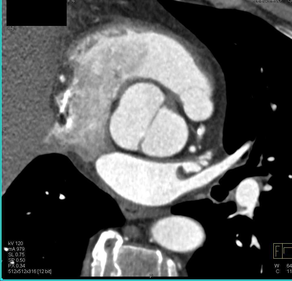 Bicuspid Aortic Valve With Early Stenosis Cardiac Case Studies