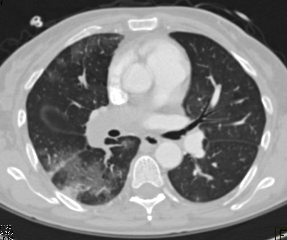 Large Pulmonary Embolism with Lung Infarct and Splenic Infarct - Chest