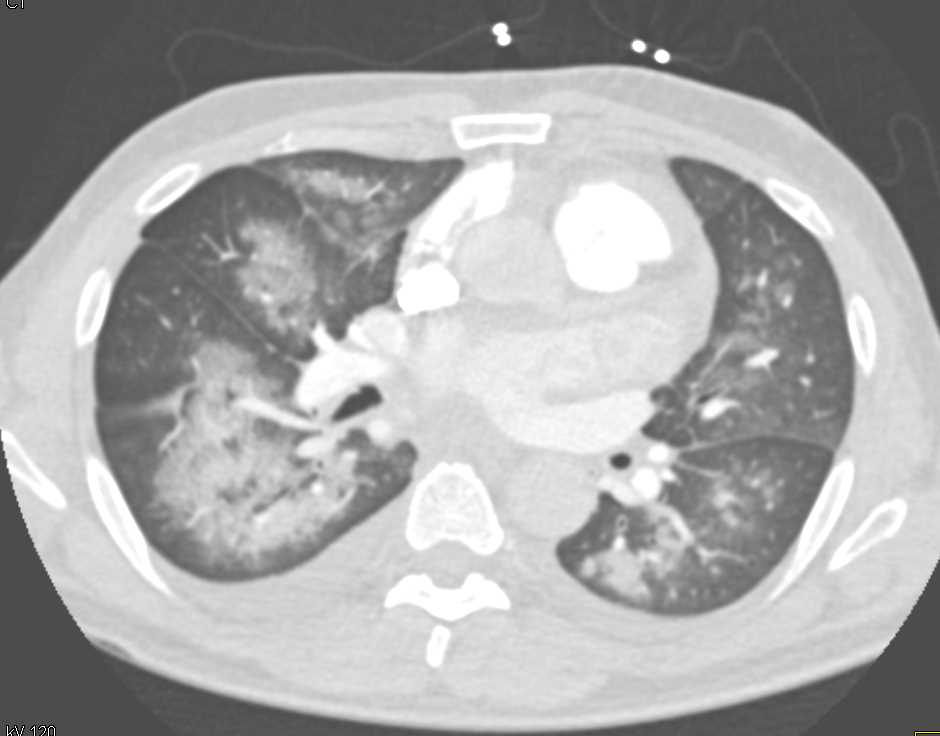 Batwing Configuration due to Pulmonary Hemorrhage - Chest Case Studies