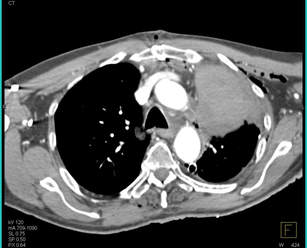 Left Upper Lobe Collapse - CTisus CT Scan